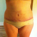 Sept. 8 (6 wks 3 days PO).  BB healing.