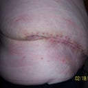 10 days post op -73 staples and 7 sutures removed.Very swollen,but happy!