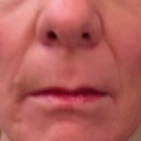 3 weeks post procedure
