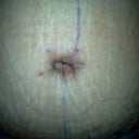 PO Revision BB. I am not sure if she redid my BB or not. Looks like she did some lipo all around here. Will ask her what was done to by BB tomorrow.
