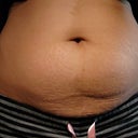 Before photo close up of stomach. Notice the stretched out shape of belly button, stretch marks, bulging and loose skin on lower abdomen
