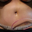After photo of stomach post-op day 4. Still swollen and has some lines from wearing the binder but a huge improvement. Almost all stretch marks are gone and no loose skin! Incision is low and belly button is oval :)