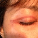 A hollow forming on the middle of the face
