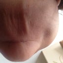 sag and wrinkle chin after a month since surgery