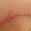 up close of the scar. I think its looking pretty good.