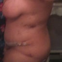 1 week post op - a lot of bruising apparent
