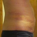 1 week after
you can see the lumps and bruises