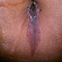 My belly button initially about 10 days after surgery