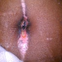 My belly button now! Slow healing process!