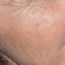 also another picure before crow's feet and brown spots