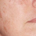 my skin after a chemical peel a couple months before