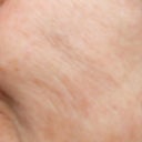 after the treatment when the swelling went down notice indents and creases, lines on my checks