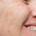 what is side it did not even get rid of brown spots just gave horrible texture with indents