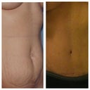 Before after having 2 babies and one year to the day post surgery