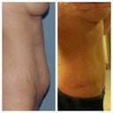 Before and one year post surgery