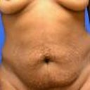 before-abdominal