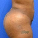 after- 1 week post op