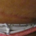 Scar is fading nicely-very thin