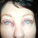 Day 1 AFTER allergy setting in