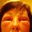 Day 3 Allergic reaction one eye closed
