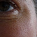 7 months after. Increased wrinkling and worse texture.