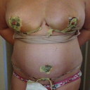 5 days Post surgery, still swollen, but getting there. :)