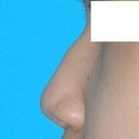 Before, Right Profile View