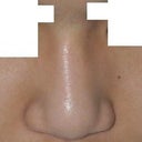 After, Straight-Down View (no before avail. of this position)