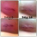No bruising, only subtle change. Still wearing tape everyday. >:(