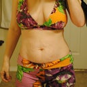 Day before surgery pic in an old bikini. This doesn't even show the saggy skin that are covered by the bottoms.