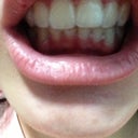 Day 1 with invisalign on