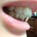 The side view doesn't do justice to how large the gap is between my upper jaw and lower jaw