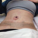 PO Day 2 - Drain-less abdominasplasty & flank lipo.