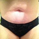 Front view Pre-surgery