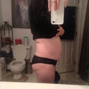 Side view Pre-surgery
