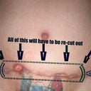 this show who much i have healed and how much my PS is going to go back in and have to re-cut out and start all over with