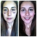 left pic- day of cast removal; right pic - 5 days after cast removal. You can see how the left side of the nose is more swollen to the right. I'm hoping that's why the tip veers to the left... Tip is swollen and so is the bridge. I think eventually it'll become more narrow and smaller as a whole. I'm very happy with this anyway! x1000 better than my original nose already!