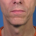 Direct Smile Line Excision Permanent Treatment For Nasolabial Folds