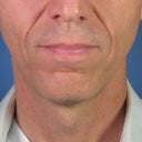Direct Smile Line Excision Permanent Treatment For Nasolabial Folds