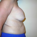 Right side. (this was the smaller breast before implants)