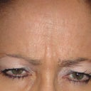 Before Botox