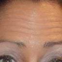 Before Botox
