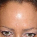 After 40 units of Botox