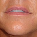After 2 syringes of Juvederm