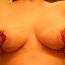 Feb 27, 2013. The day after operation after taking drains out. Tape had to stay one more day.