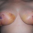 March 5, 2013. After my post-op appointment.