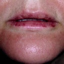 lips after Juvederm treatment