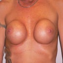 41 Yea Rold Woman Has Breast Implant Exchange