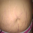 The stretchmarks  :(