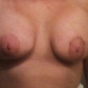 Front view 3 weeks post op. Nipples are low, and implants too high.